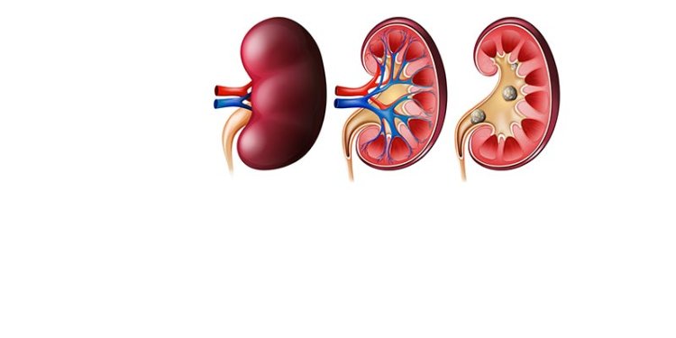 What Should You Eat If You Have Kidney Stones?