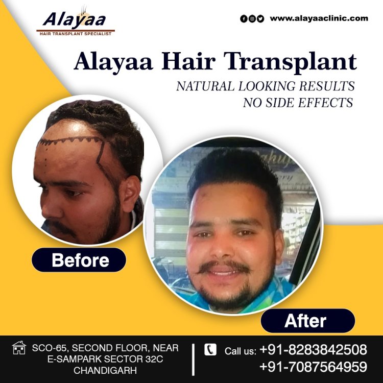 FUE Transplant Chandigarh Before & After Fue Hair Transplant Specialist in Chandigarh