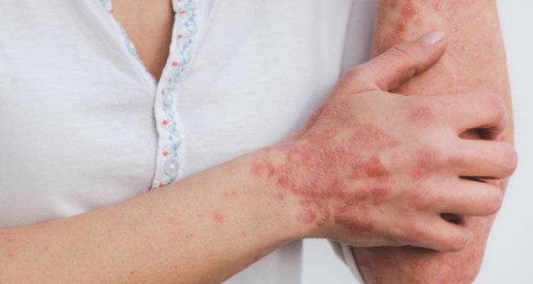Get Effective Psoriasis Treatment in Pune and Get Relief Now!
