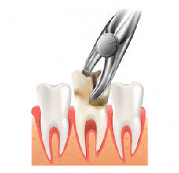 Best dental Clinic for Teeth extractions in Kukatpally, Hyderabad
