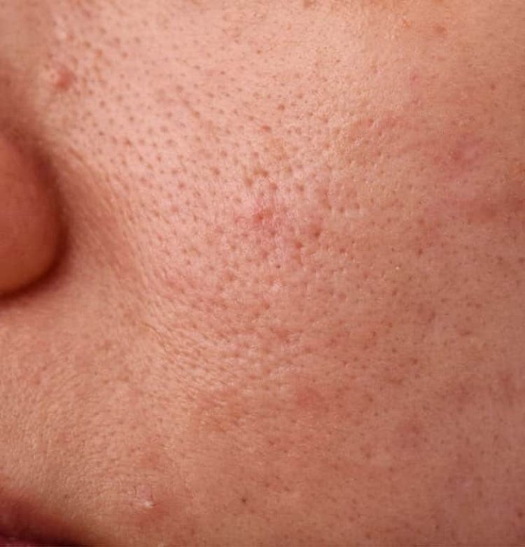 How Can I Get Rid Of Open Pores