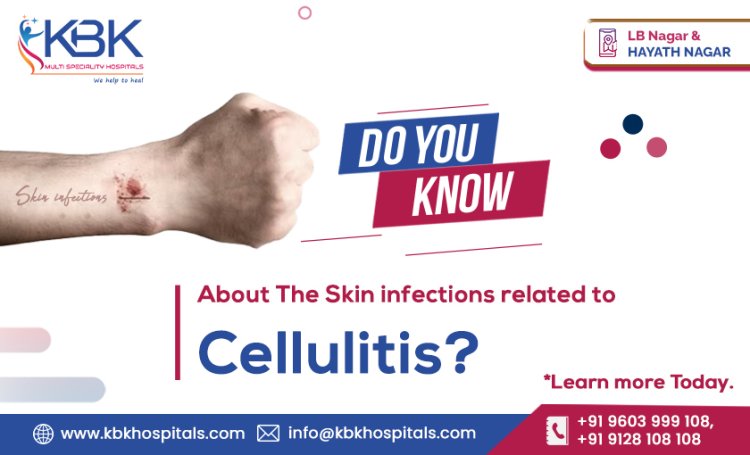 Do you know about the Skin infections related to Cellulitis? Cellulitis Treatment in Hyderabad