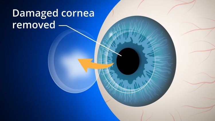 You Need to Know About Cornea Transplant