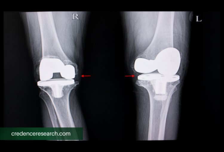 Cementless Total Knee Arthroplasty Market Rising Trends and Research Outlook 2022-2030