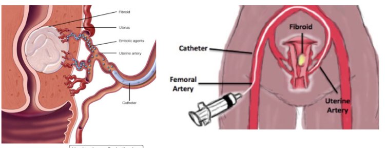 Uterine Fibroid Treatment In Delhi﻿