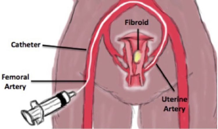 Uterine Fibroid Treatment In Delhi