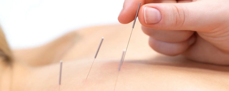 Unlocking the Healing Power: Dry Needling and IMS Services in Surrey by Legend Physiotherapy