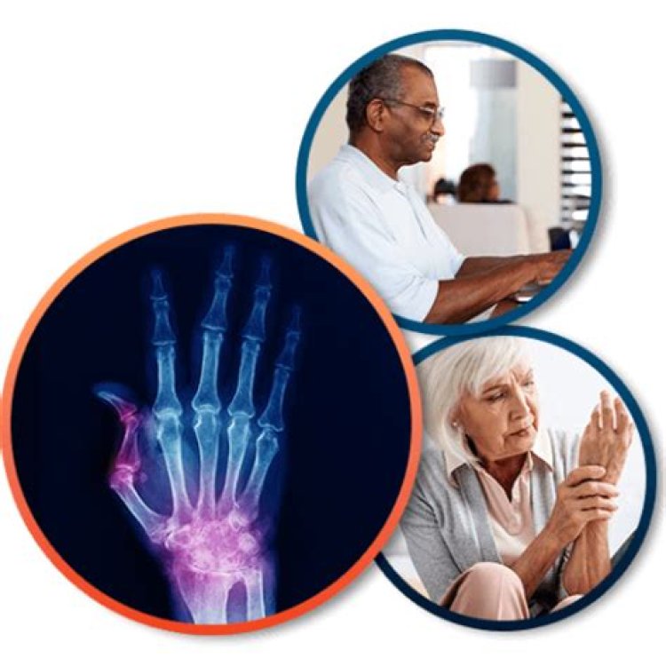 Rheumatology Clinical Trials Thousand Oaks