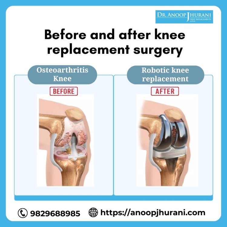 Before and After Knee Replacement Surgery