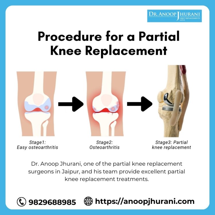 The Procedure for a Partial Knee Replacement