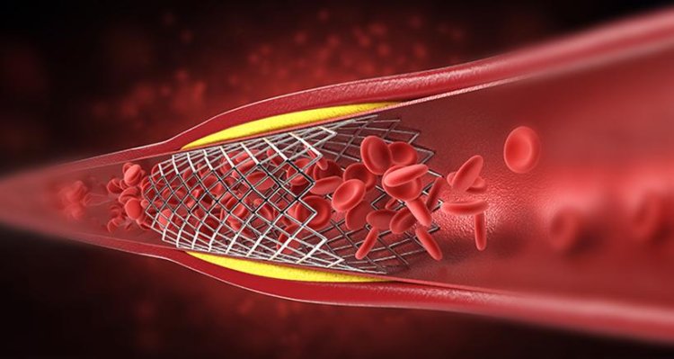 Angiography and Angioplasty: Uncovering Their Purpose, Mechanism, and Risks