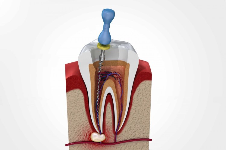 Root Canal Center In Dwarka