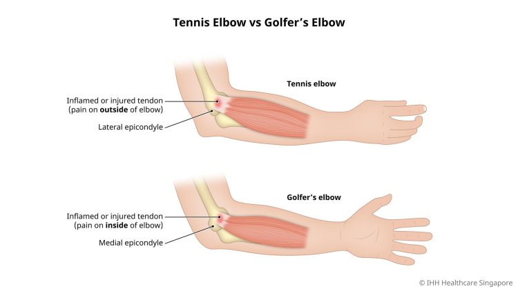 Finding Relief Naturally: Homeopathic Treatment for Tennis Elbow