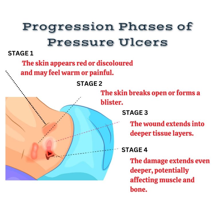 Progression phases of pressure ulcers | Synerheal Pharmaceuticals