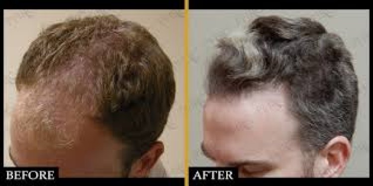 The Role of PRP Therapy in Enhancing Hair Transplant Results in Houston
