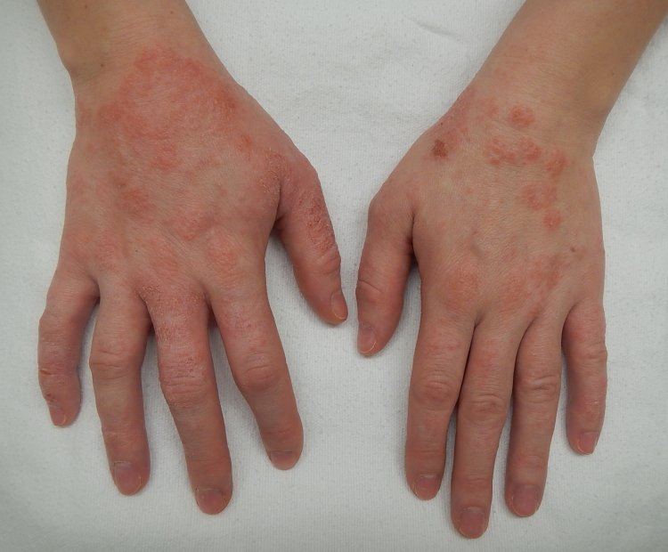 USA comprehensive overview of  Dyshidrotic eczema