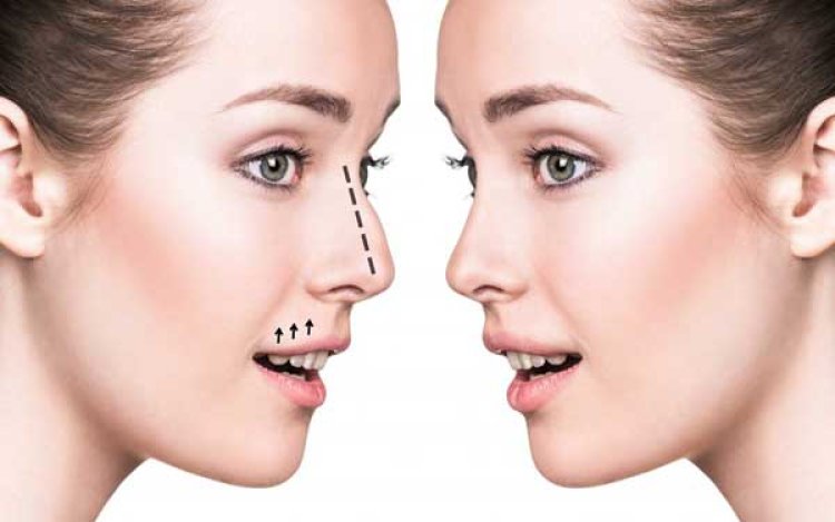 Rhinoplasty Surgery in Delhi