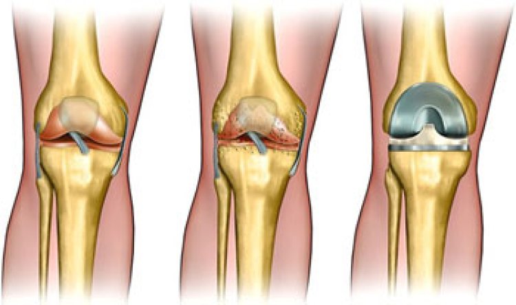 ACL Reconstruction Surgery in Delhi, India