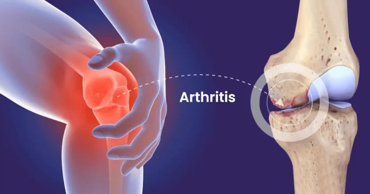 Arthritis Monoclonal Antibodies Market Advance Technology, Business Overview, Forecast 2033