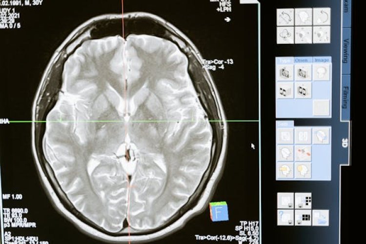Acute Ischemic Stroke Diagnosis Global  Market 2024 - By Size, Demand, Share, Trends, Forecast To 2033