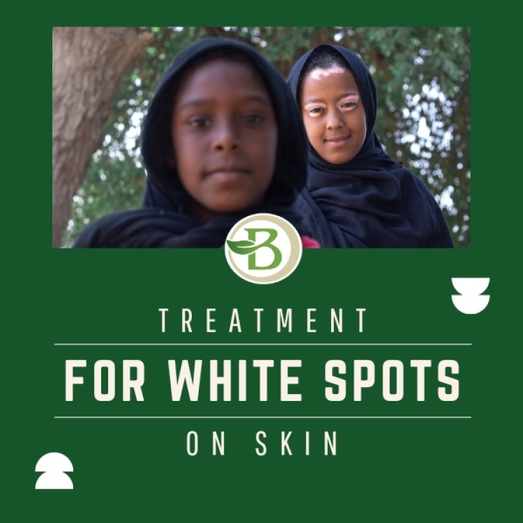 Vitiligo Disease Treatment: Natural Treatment for White Spot on Skin