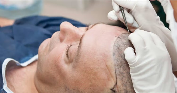 Get to know about hair transplantation, its approaches and hidden facts