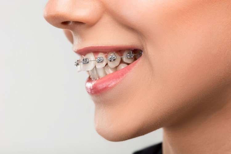 Achieve a Perfect Smile: Braces at Prestige Dental in Fort Worth