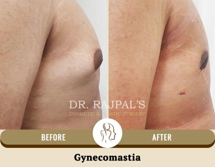 Rebuilding of Male Confidence after Gynecomastia Surgery by a Plastic Surgeon in Delhi.