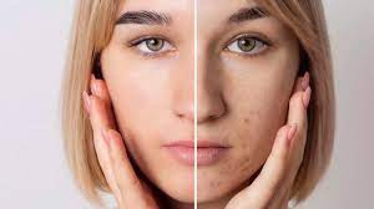 Several natural remedies and acne creams that can help reduce their appearance over time