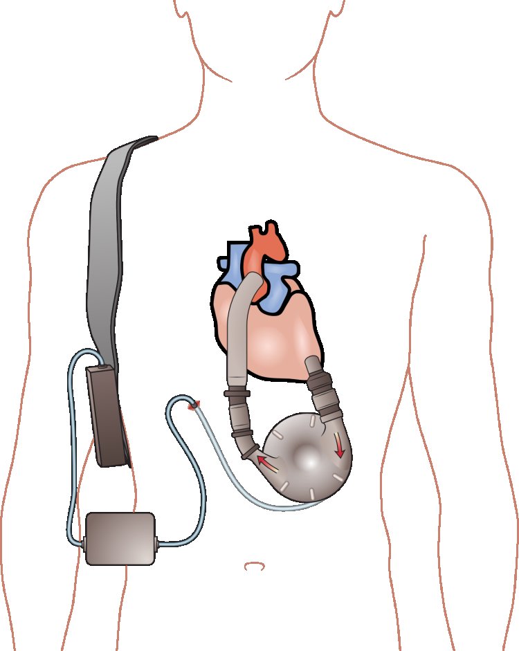 Congestive Heart Failure Treatment Devices Market Opportunities, Size, Share, and Analysis 2024-2033