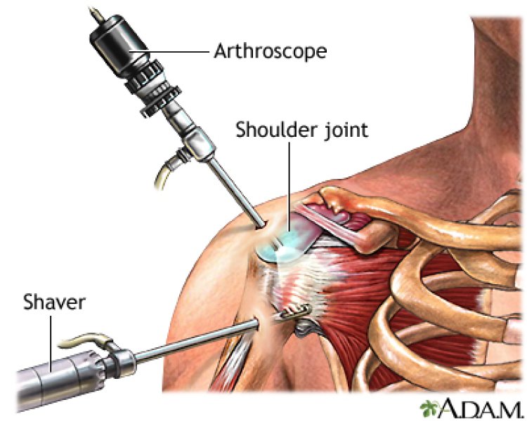 Best Shoulder Replacement Surgeon In Delhi - Dr Nikhil Verma