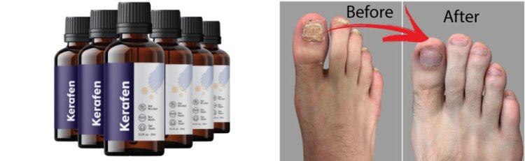 Is Kerafen the Best Solution for Toenail Fungus? User Insights