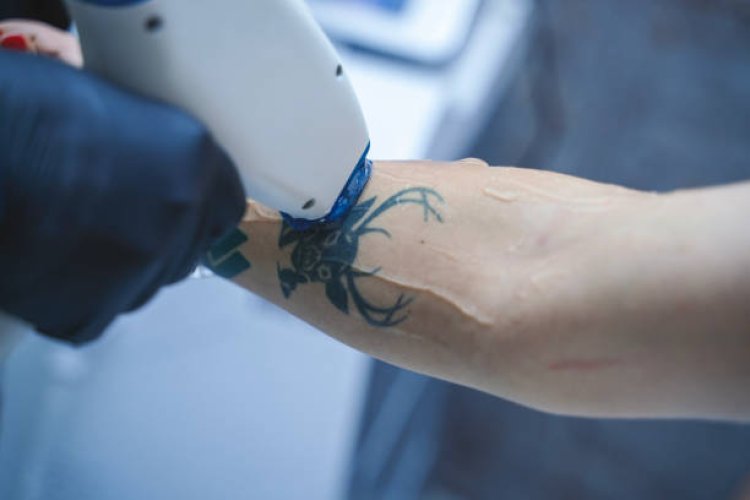 Best Laser Tattoo Removal in Abu Dhabi: Clear Your Skin