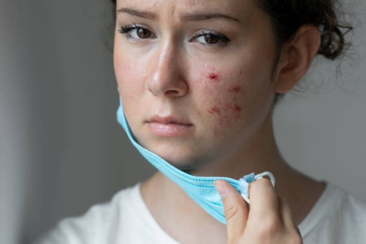 Acne Treatment in Abu Dhabi: Clearer Skin Guaranteed