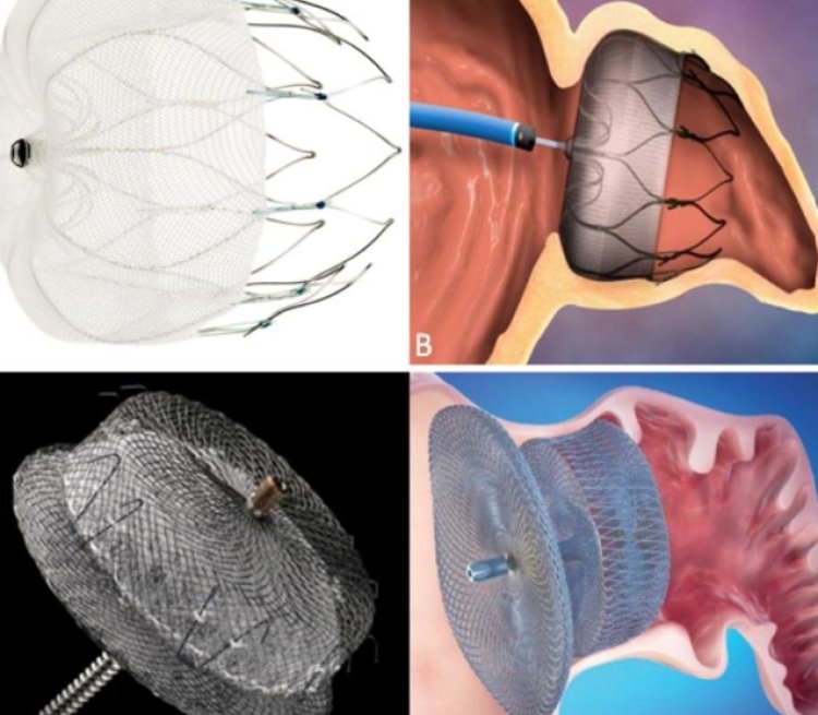 Left Atrial Appendage Closure Device Market Growth Analysis 2024 – Forecast Market Size And Key Factors Driving Growth