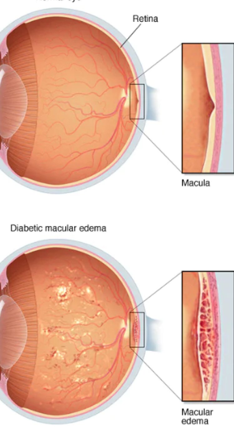 Macular Edema and Macular Degeneration Market Report 2024-2033: Size, Trends, Analysis, Insights, and Overview