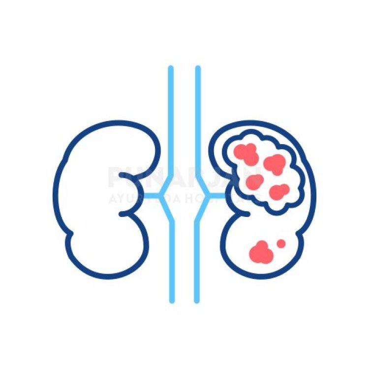 Best Kidney Cancer Treatment Hospitals in Hyderabad