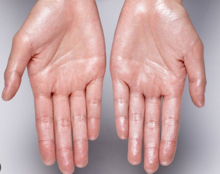 Hyperhidrosis Treatment Market Size Trends, Growth, and Outlook 2024-2033