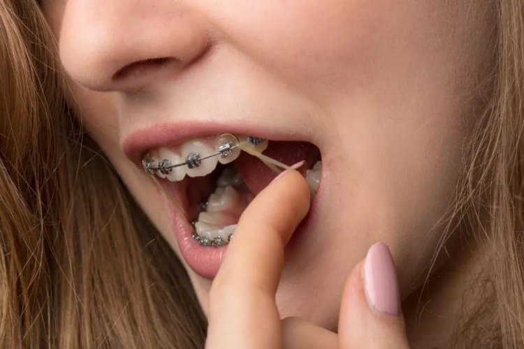 Orthodontic Supplies Market Growth and Trends, Analysis And Forecast to 2033