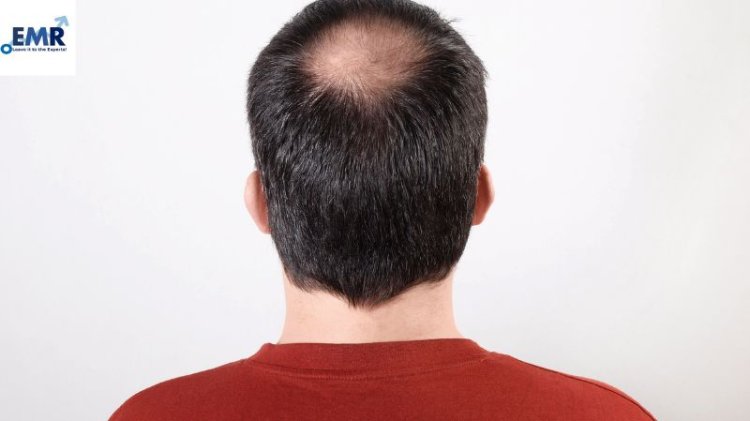 Crecimiento del Mercado de Alopecia: Proyecciones y Tendencias