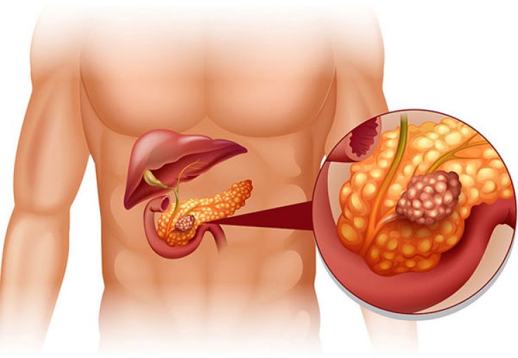 Gallbladder Cancer: What You Should Know