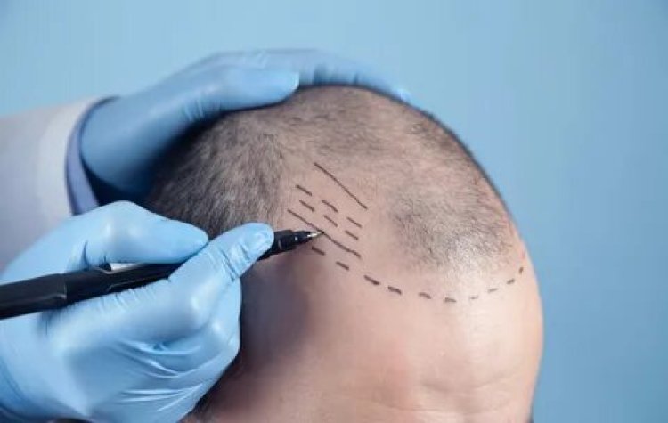 How to Manage Hair Transplant Scars: Insights from Riyadh Specialists