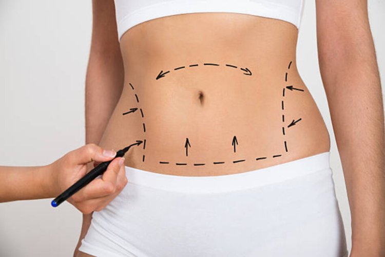 Ultimate Guide to Liposuction Surgery in Dubai 2024