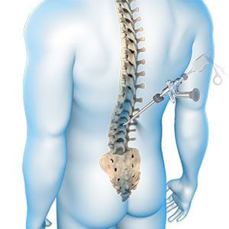 How Serious is Spinal Decompression Surgery?