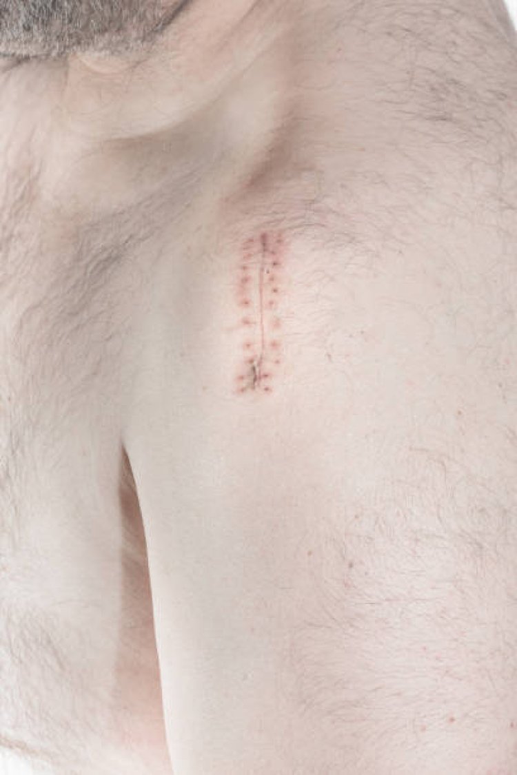 Surgical Scar Revision for Trauma Scars in Abu Dhabi