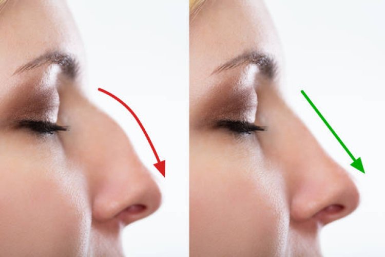 Best Clinics for Rhinoplasty in Dubai: A Comprehensive Guide