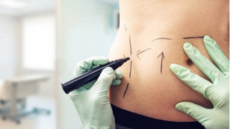 Expert Liposuction Surgeons in Abu Dhabi