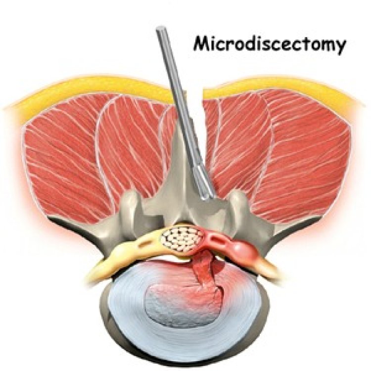 Is Microdiscectomy a Major Surgery?