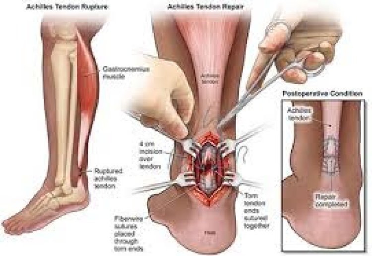 Achilles Tendonitis Treatment Center