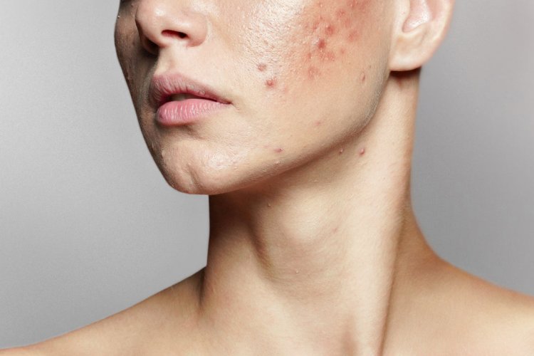 Skin Purging: What is It and Which Ingredients Can Cause it?